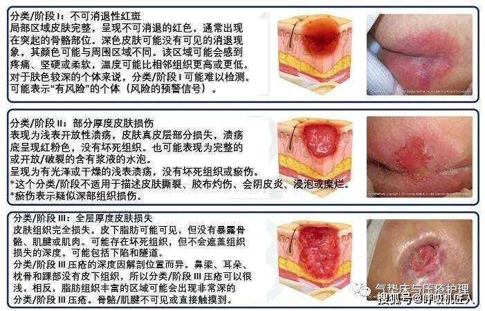 最新壓瘡分期詳解及應(yīng)對(duì)策略