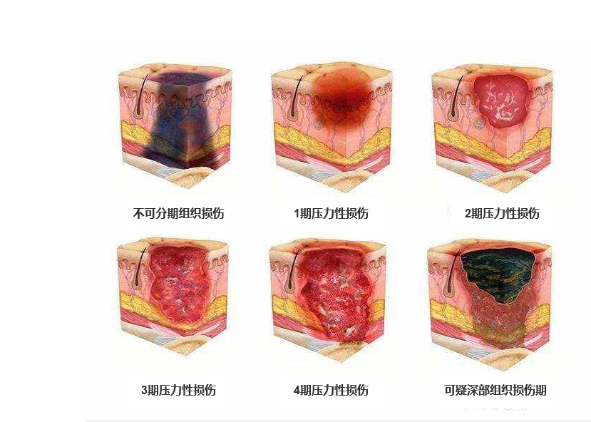 最新壓瘡分期詳解及應(yīng)對(duì)策略