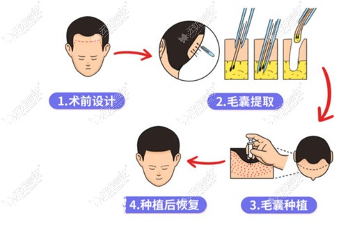 最新植發(fā)技術(shù)，重塑自信的秘密武器