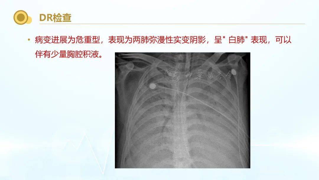 新形冠状肺炎最新增情况分析，疫情动态与趋势探讨