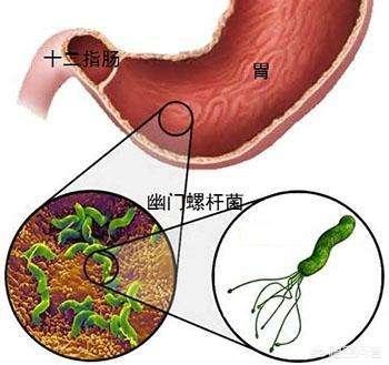 幽门螺杆菌治疗最新药物研究进展揭秘，探索最新药物疗法